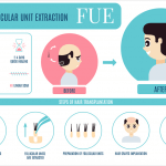 FUE Hair Transplant Cost In Pakistan