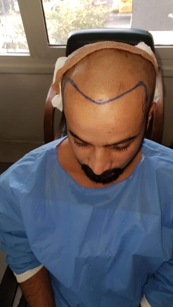 hair transplant islamabad