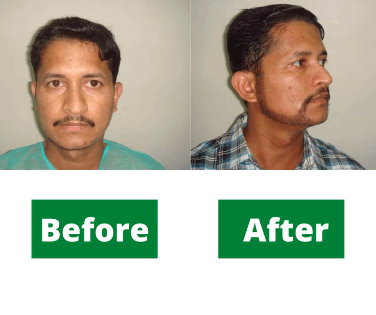beard hair transplant in pakistan