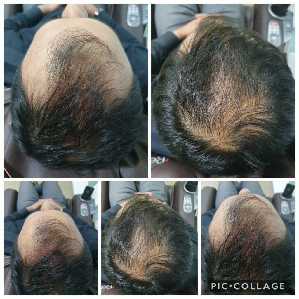 Hair transplant Islamabad
