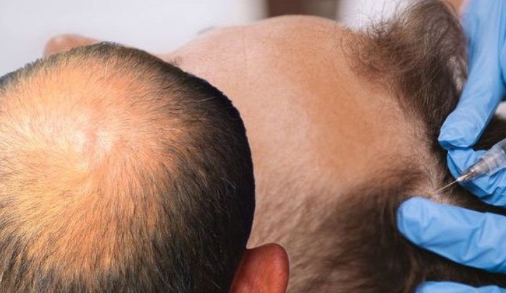 Benefits of PRP After Hair Transplant (2023 Guide) – HairHub