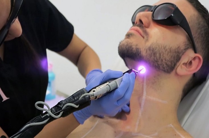 Does Bleaching Affect Laser Hair Removal in Pakistan