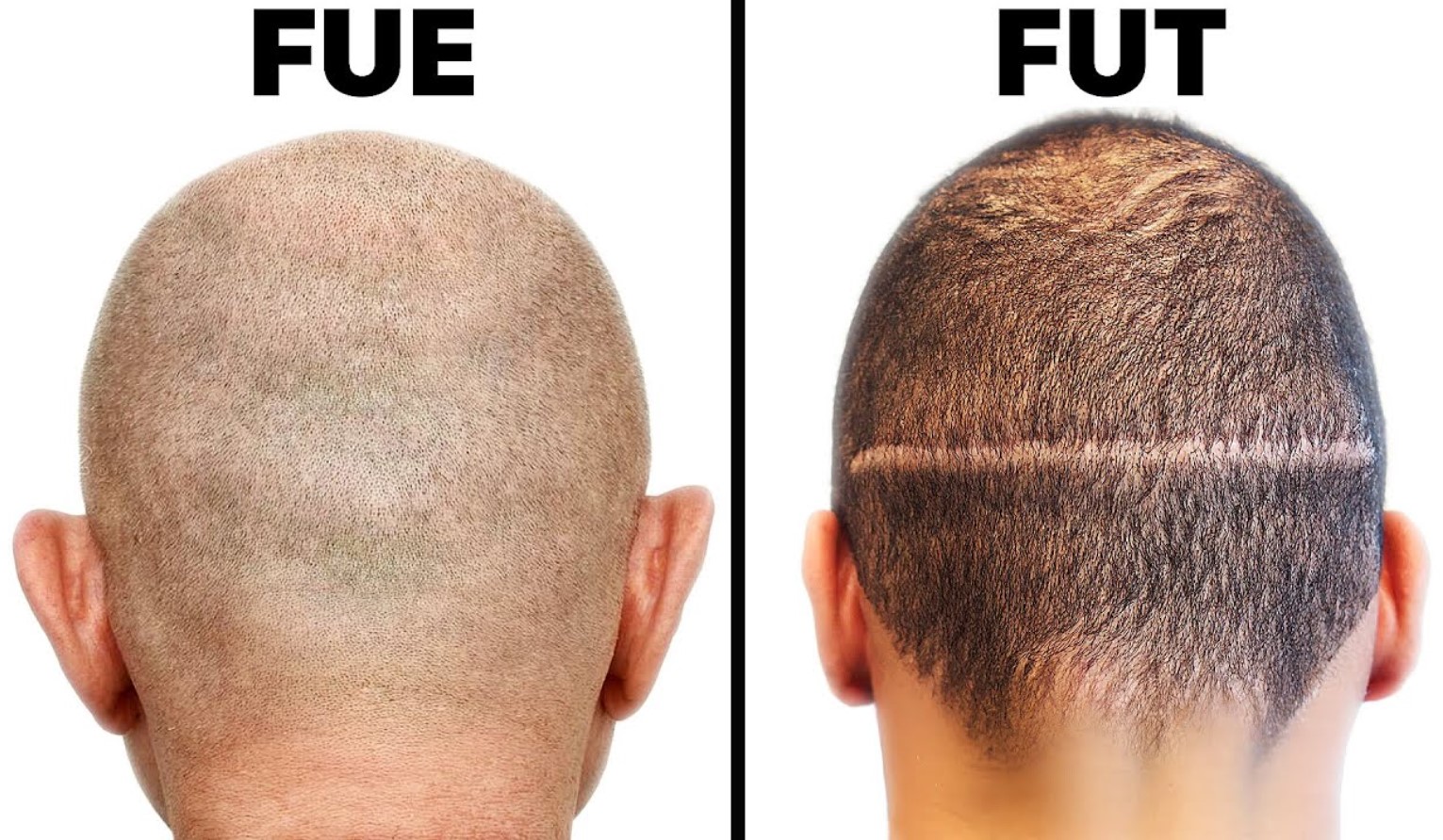 FUE vs. FUT: Which is the Superior Hair Transplant Method? | HairHub