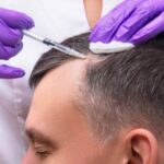 Does PRP Regrow Hair Permanently? Unraveling the Truth
